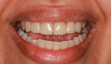 Causes and Treatment for Yellow Teeth | Asnan Tower
