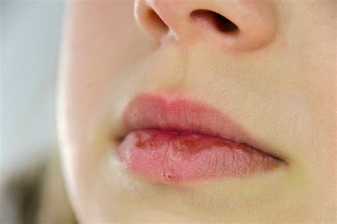Cold Sore Remedies: 17 Homemade Treatments That Work