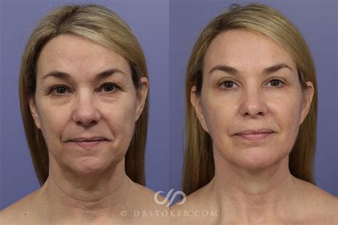 Traceless Mini Facelift Los Angeles & Santa Monica | Dr. David Stoker