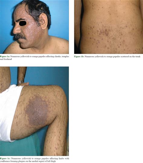 Rosai Dorfman 20.1.2 Massive Lymphadenopathy Or Rosai Dorfman Disease