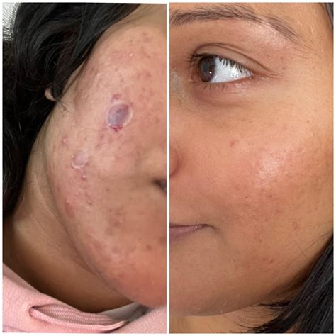 6 month transformation using Dermatica - Adapalene 0.3% / Benzoyl Peroxide 2.5% / Clindamycin 1% ...