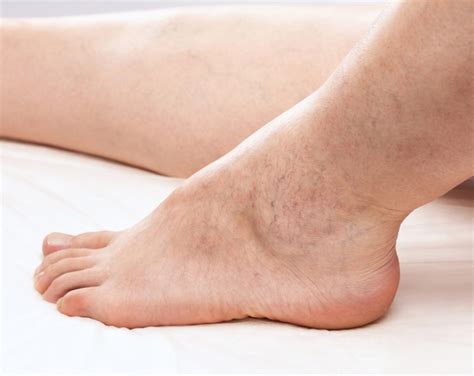 Insuficiencia venosa crónica, ¿qué es?