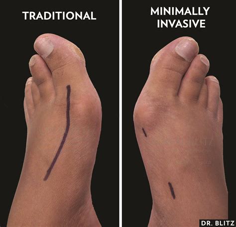 Types Of Bunion Surgery at Sophie Catani blog