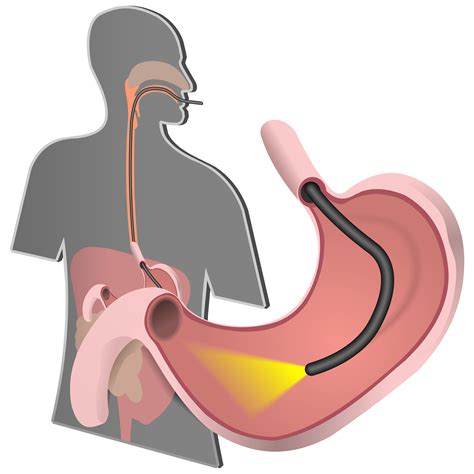 What Is Ercp Procedure at Blanche Robins blog