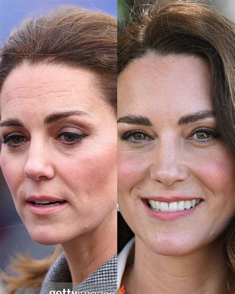 Kate Middleton Face Surgery
