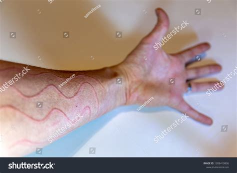 Dermatographic Urticaria Known Dermographism Dermatographism Skin Stock Photo 1308419836 ...