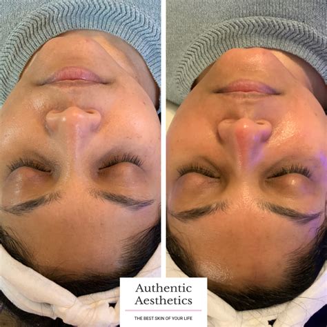 Dermaplaning - Authentic Aesthetics