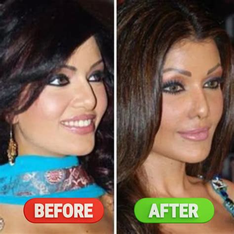 Plastic Surgery Gone Wrong