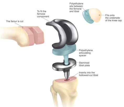 Patient's Guide to Total Knee Replacement - ATX Orthopedics