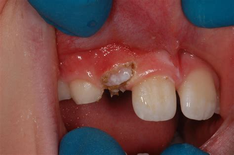 Impacted canine tooth - Need impacted canine tooth surgery?