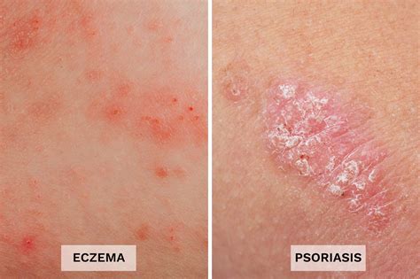 Pictures Of Psoriasis And Eczema