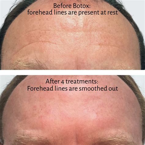 Can Botox treat deep forehead wrinkles? Yes! Here’s how. | Ageless Aesthetics & Natural Medicine ...