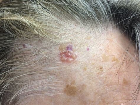 Basal Cell Cancer Neck at William Mathers blog
