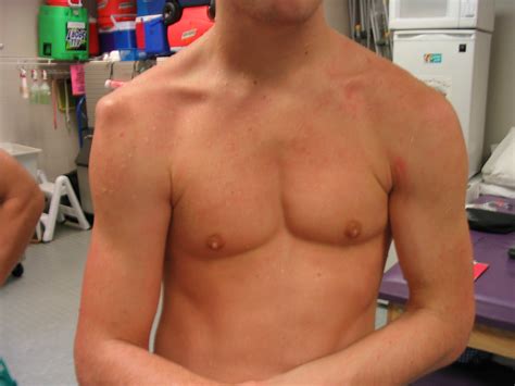 Problems Resulting From Shoulder Dislocation