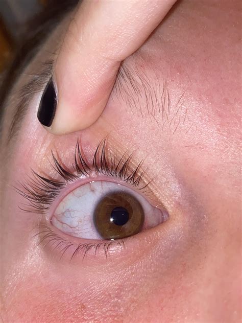 White Bump On Eyelid Causes Treatment Remedies Pictures Molluscum