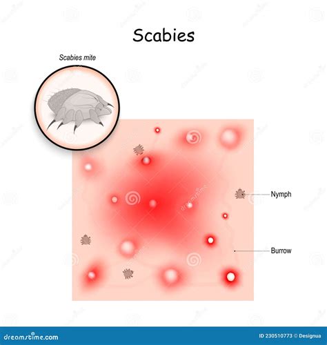 Scabies Mite On Skin