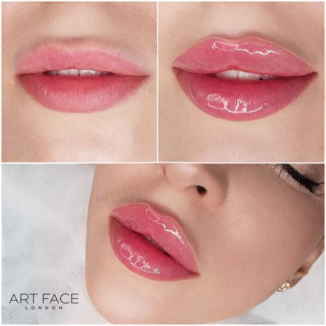 Russian lip filler before and after – Artofit