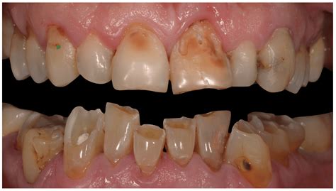 Celiac Disease & Brown Spots on Teeth - Is there a Link?
