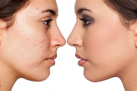 Tetracycline Acne Before And After