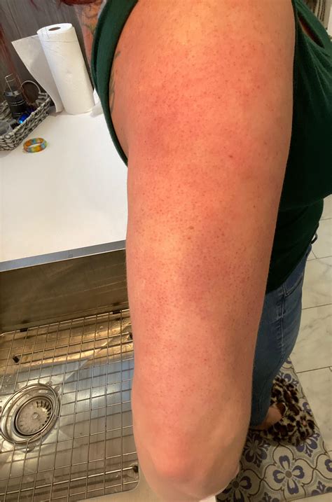 Redness On Upper Arms What's The New Phenomenon Called “COVID