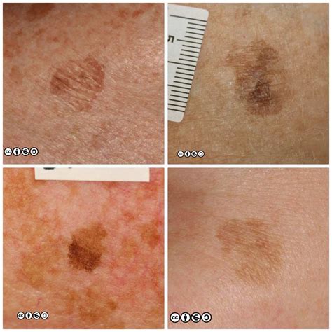 Best Cares of Brown Spots Suddenly Appearing on Skin 2026