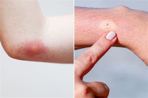 Bumblebee Stinging Pictures: Scary Symptoms & Easy Treatments
