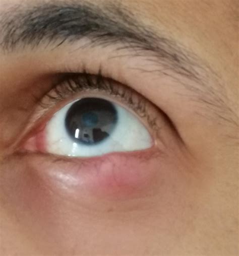 Ask a Eye Specialist Online for Swollen Eye Lid
