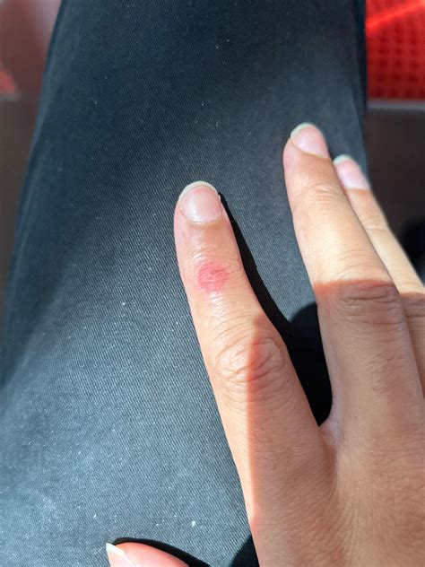 Is this infected ? Friction burn : r/woundcare