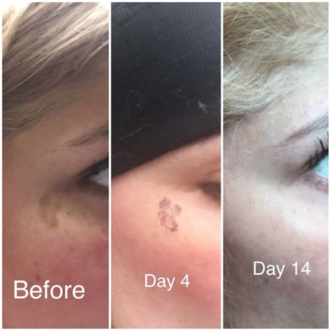 Syawa Nigma: Age Spot Removal Before After Photos