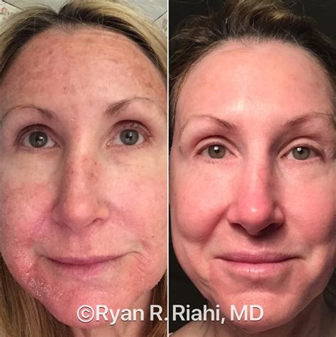 Wrinkled Skin From Sun Damage Cosmex Clinic | Sun Damage Cambridge