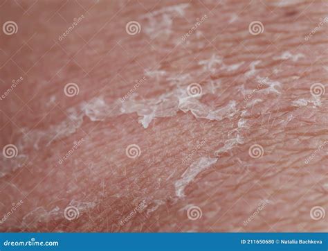 Problematic Human Skin Close-up with Burn, Redness and Peeling after Sunburn Stock Photo - Image ...