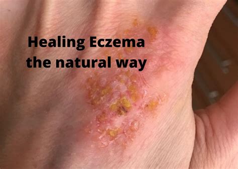How To Make Face Eczema Go Away at Ruth Madison blog