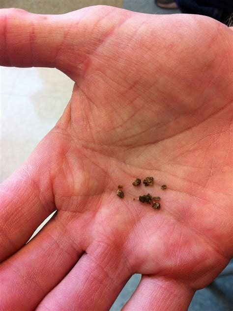 Kidney Stone Color Chart