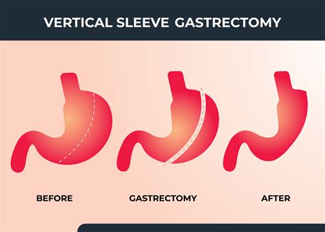 Vertical Sleeve Gastrectomy