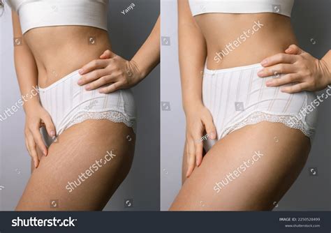 10,185 Stretch Mark Background Images, Stock Photos & Vectors | Shutterstock