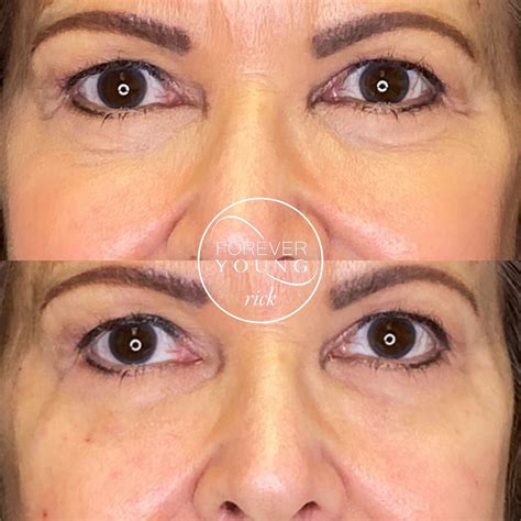 Upper Face - Injectables - Florida