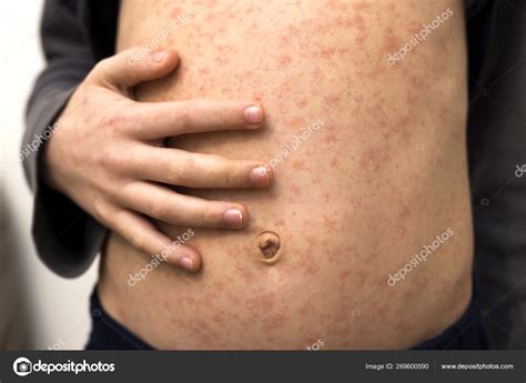 Sick child body, stomach with red rush spots from measles or chicken pox. Contagious child ...