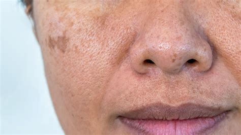 Mole vs. freckle: Understanding the difference between moles and freckles | Spot Check: skin ...