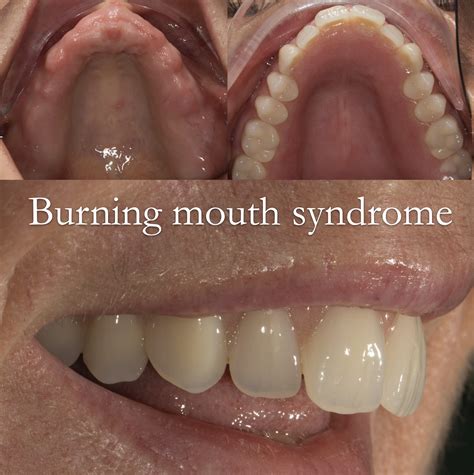 Bad Mouth Syndrome at Maria Ayotte blog