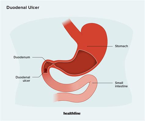 Gastric Ulcer Vs Duodenal Ulcer Stomach In Situ