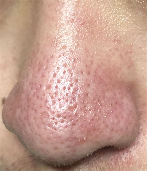 Infected Pores On Nose