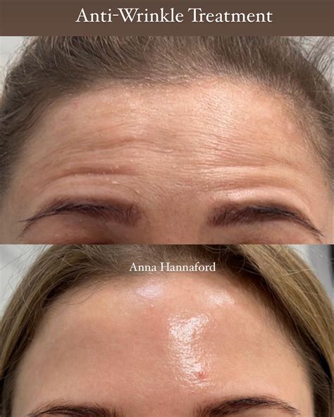 Transformations: Anti-Wrinkle and Dermal Fillers Before and After