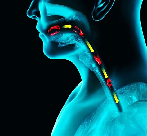 Esophageal Motility Disorders Specialist - Dallas, Plano, & Tyler, TX: Center for Advanced ...