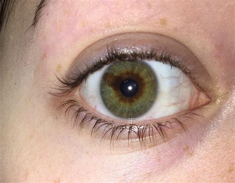 Heterochromia Brown Green