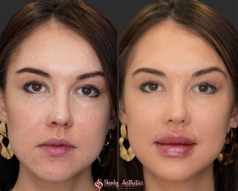 Russian Lip Filler Technique - Benefits, Costs & Results