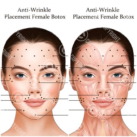 Botox Injection Points Bundle | Botox & Filler Injector | Anatomy | Art | Esthetician ...