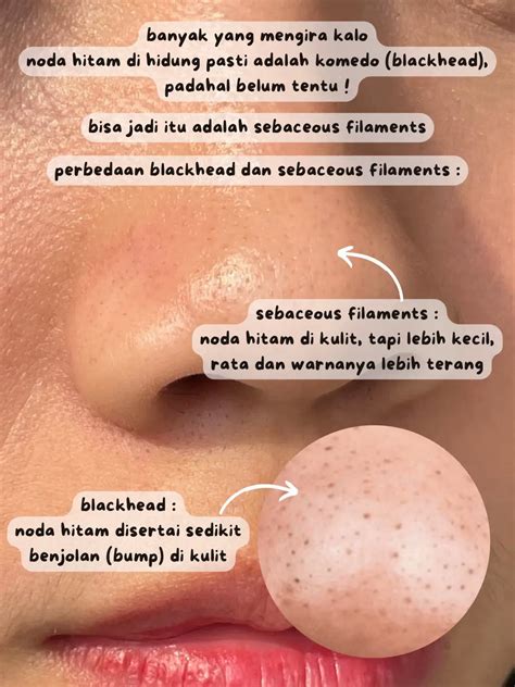 cara efektif menghilangkan sebaceous filament ️ | Galeri diposting oleh yessicanggriani | Lemon8