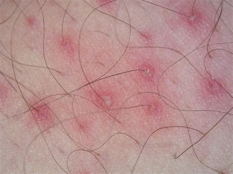 How Long Does Folliculitis Last