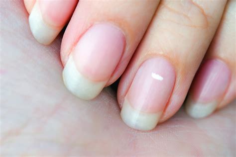 White Spots Under Fingernails
