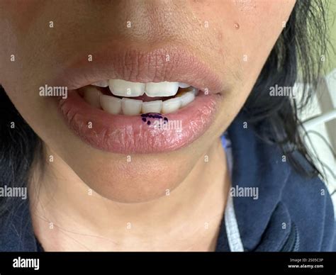 Mucocele on the lip of a female patient marked for excision. A mucocele, or mucus retention cyst ...